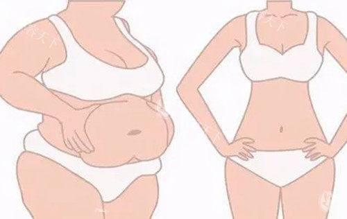 全身吸脂前后对比示意图