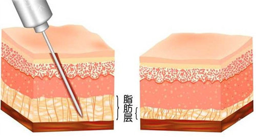 吸脂手术怎么做的