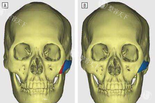 2025北京黄大勇做颧骨内推价格表更新！3.8万起还含技术费？附全项目明细
