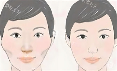 颧骨内推术前后对比动画图