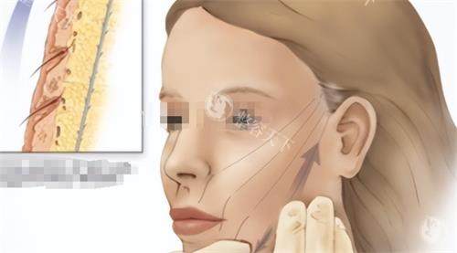 无痕筋膜提升2.0价格大揭秘！不同部位、多种因素影响几何？带你深入了解费用详情