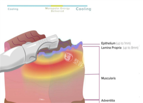 viveve薇蜜私密紧致仪器可以深入的层次图解