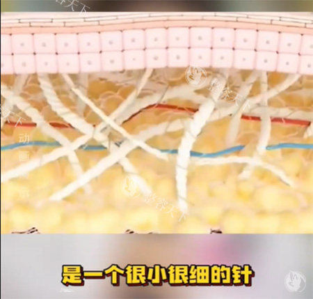 私密处松弛困扰多，私密紧缩针和激光疗法怎么选？了解这些优势劣势让你做对决定！