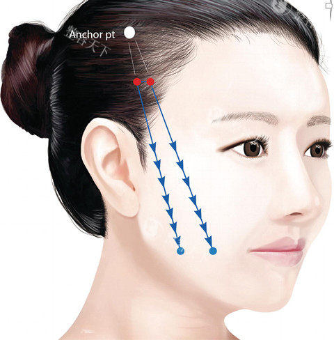 还在纠结筋膜提升和线提升选哪个？这篇深度对比让你认清两者差异，选对抗衰项目！