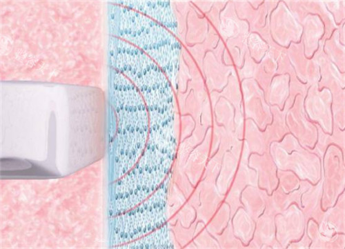viveve薇蜜私密紧致仪器施术过程图解