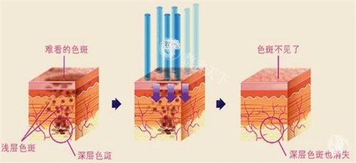 想了解皮秒祛斑的费用一般是多少吗？快来看看不同医院、不同情况皮秒祛斑的价格差异