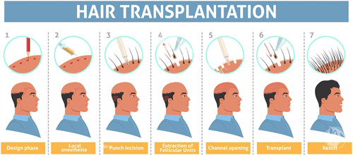 头发种植流程图一览