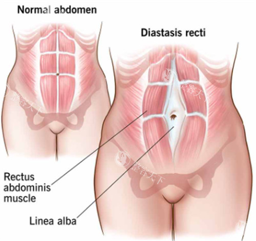 西安刘宾医生做腹壁整形超严峻！三层缝合技术精，疤痕隐蔽修养快