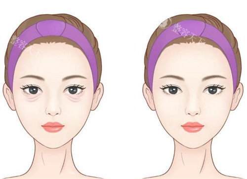 盘锦做眼袋大概什么价位？基础内切法5000元起，外切法8000元起，激光3000元起