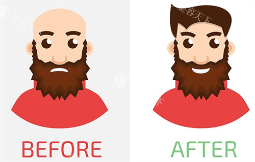 植发手术对比图