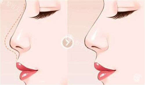 隆鼻手术对比图