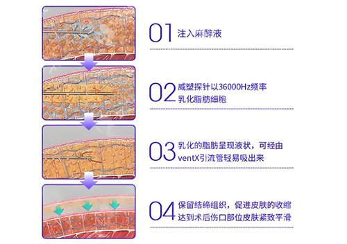 威塑吸脂手术步骤演示动画图