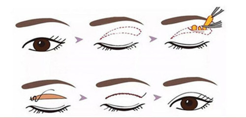 正常鼻子和过长的鼻子矫正对比