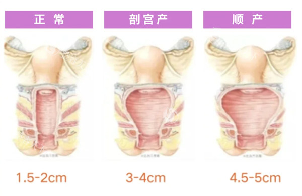 正常阴道和松弛对比照片