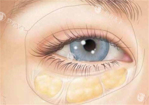 成都高富雷做眼袋技术好且无失败实例！新丽美/悦好整形多院区坐诊 + 内切祛眼袋5000元起价格透明