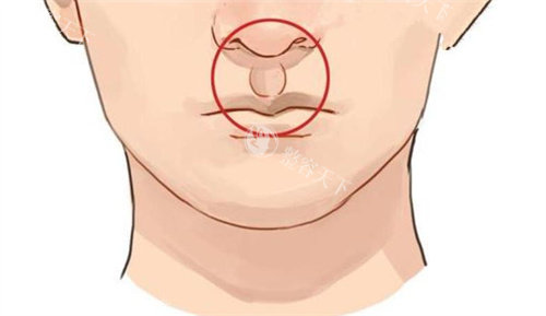 人中加深手术后