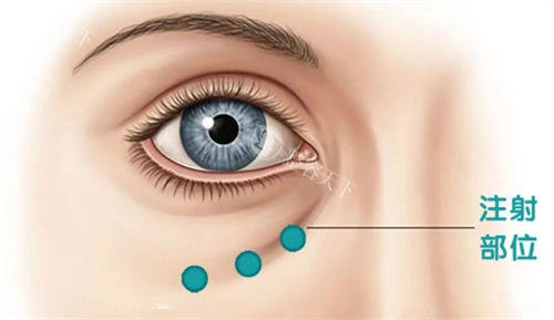 泪沟注射部位示意图