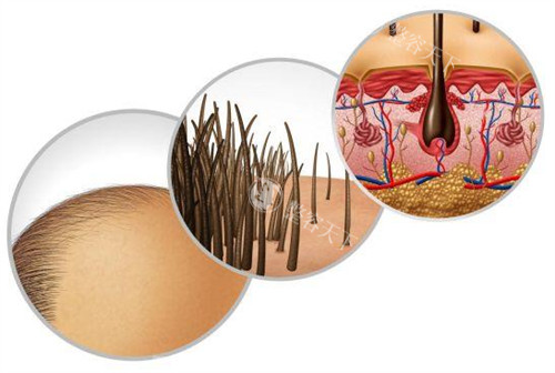 脂溢性脱发造成的问题