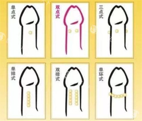阴茎入珠术款式