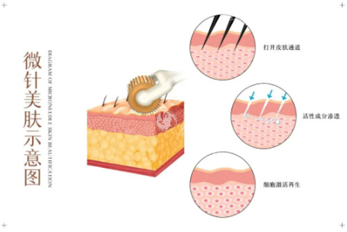 杭州星纪整形黄金微针简介:全脸880元起_小创口抗衰_分院便捷_支持在线预约!