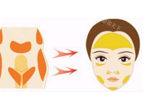 脸部脂肪填充图片