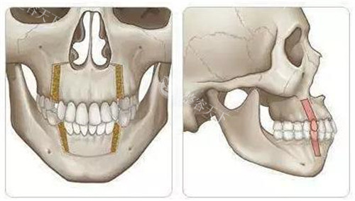 偏颌正颌手术前后对比图鉴！20例真实病例告诉你骨性凸嘴矫正结果有多绝~