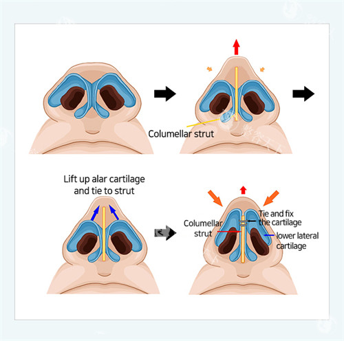 缩鼻翼后悔率调查！300人术后回访发现：这3种鼻型千万别轻易动刀~