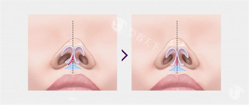 歪鼻和正常鼻子