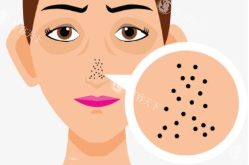 鼻子毛孔粗大卡通图