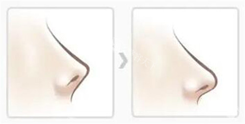 鼻子朝天矫正改善