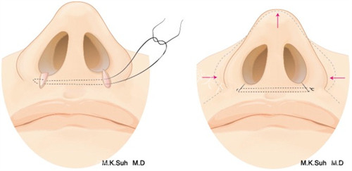 鼻孔缩小手术前后对比