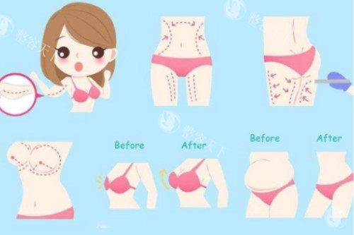 吸脂塑形卡通概念图