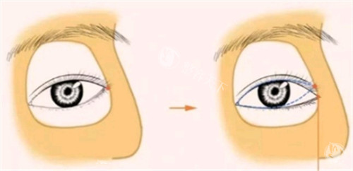 开外眼角手术设计图