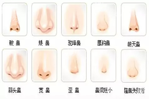 不美观鼻型示意图