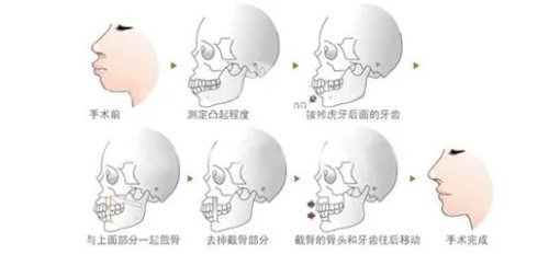 正颌手术步骤图示