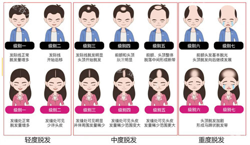 不同程度的脂溢性脱发