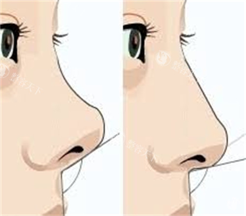 隆鼻手术膨体隆鼻前后对比