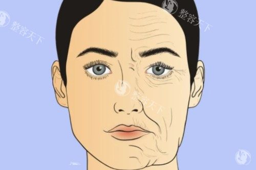 面部衰老提升卡通对比图