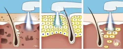 光子嫩肤的过程
