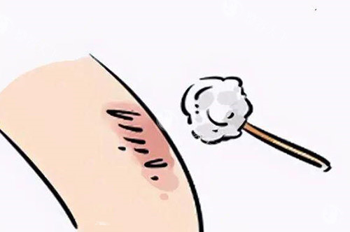 上海祛疤纠结选宏康疤痕科还是虹桥疤痕科？真实体验+对比分析帮你避坑