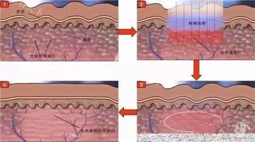 40岁皮肤救星？光子嫩肤和水光注射怎么选？看色斑、干纹对应方案！