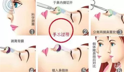 隆鼻过程图解