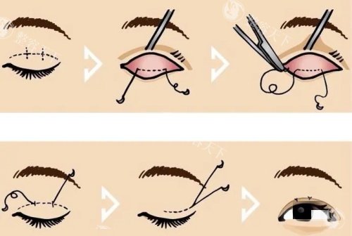 广州陈贵宗修复双眼皮靠谱吗？显微级操作 + 术后回访，老患者说了实话