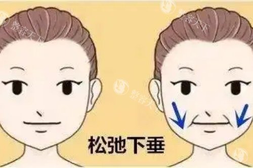 嘴角松弛下垂对比图