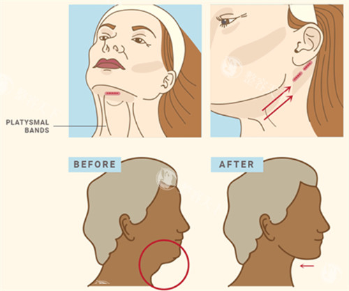 面部提升改善下颌