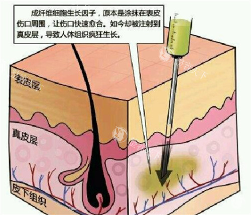 生长因子能打在脸上吗？明确不可注射且有潜在风险需知晓