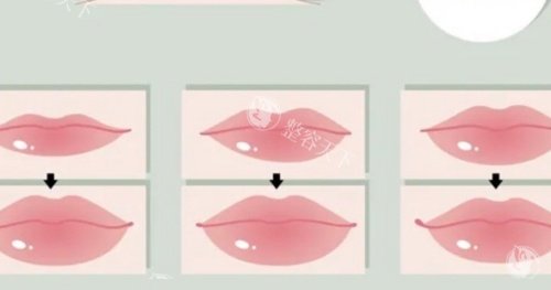 丰唇注射过程示意图