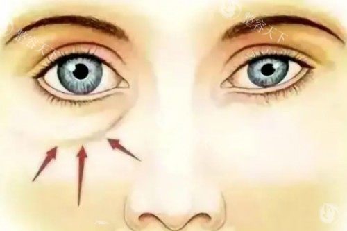 泪沟卡通展示图