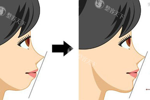 告别下巴后缩困扰！儿童到成人各阶段矫正方法大揭秘