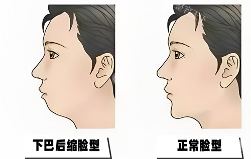 下巴后缩与正常脸型对比动画图